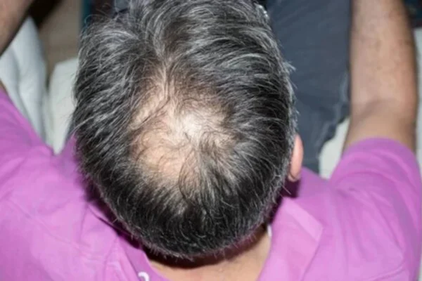 Adeus, minoxidil: conheça novos tratamentos contra a calvície