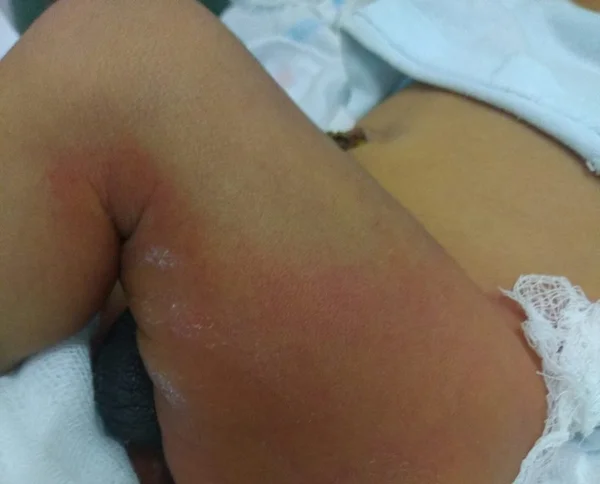 Bebê vai para UTI após ser queimado durante banho em maternidade