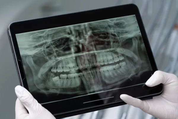 Imagem mostra um exame de raio-x da boca sendo visto em um tablet. Metrópoles