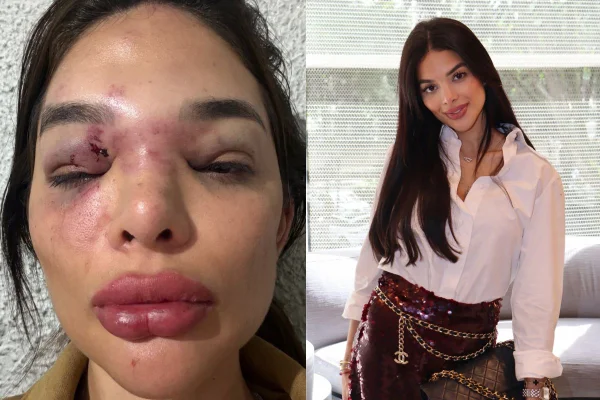 Mulher vítima de violência doméstica - Metrópoles