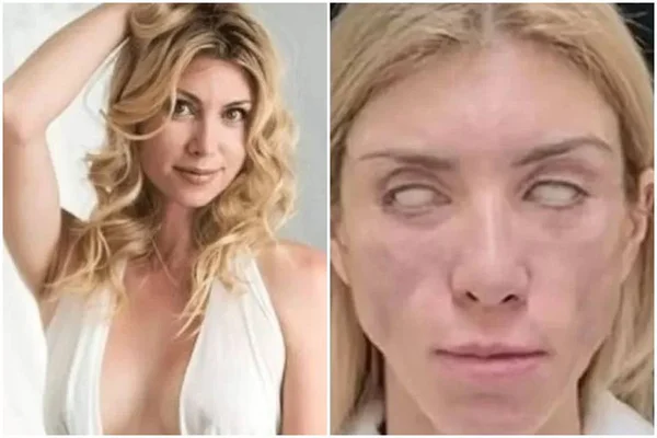 Após cirurgia plástica, miss não consegue fechar os olhos nem sorrir