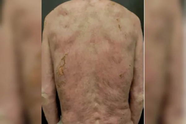 Fotos mostram a evolução de tratamento da necrólise epidérmica tóxica