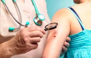 Outro sinal característico da existência de um câncer é a modificação do aspecto de pintas. Mudanças no tamanho, cor e formato também devem ser investigadas, especialmente se descamarem, sangrarem ou apresentarem líquido retido