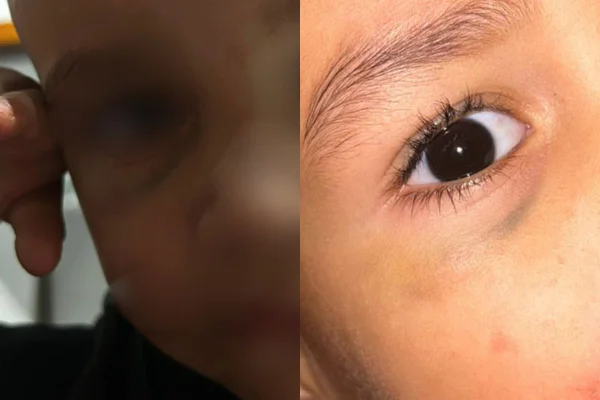 Creche está sendo investigada por maus-tratos após mães denunciarem que as crianças estavam retornando para casa com hematomas e mordidas - Metrópoles