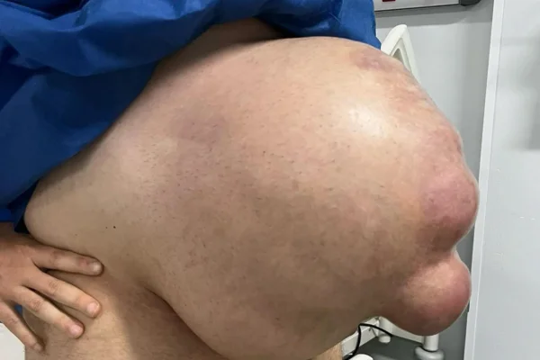 Foto colorida de hérnia gigante localizada no abdomén de um homem - Metrópoles