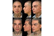 MC Guimê mostrou o resultado da harmonização facial nas redes sociais MC Guimê mostrou o resultado da harmonização facial nas redes sociais