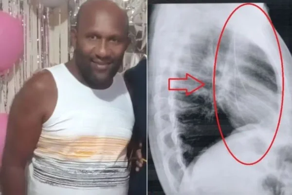 Imagem colorida mostra uma montagem onde, na parte direita, está um raio-x indica um objeto estranho alojado perto do coração de um homem. A esquerda, o paciente que foi a vítima do erro médico - Metrópoles