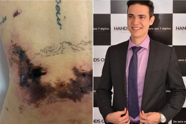 Mulher mutilada ao lado de homem de terno