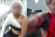 Mulher tem 36% do corpo queimado