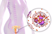 <b>Gonorreia e infecção por Clamídia -</b> Na maioria das vezes, as duas doenças estão associadas. A infecção atinge os órgãos genitais, a garganta e os olhos. Quando não é tratada, a gonorreia pode levar à infertilidade. Os principais sintomas em mulheres são dor ao urinar ou no pé da barriga (baixo ventre), corrimento amarelado ou claro fora do período de menstruação, dor ou sangramento durante a relação sexual. Os homens costumam sentir ardor e esquentamento ao urinar, corrimento ou pus e dor nos testículos