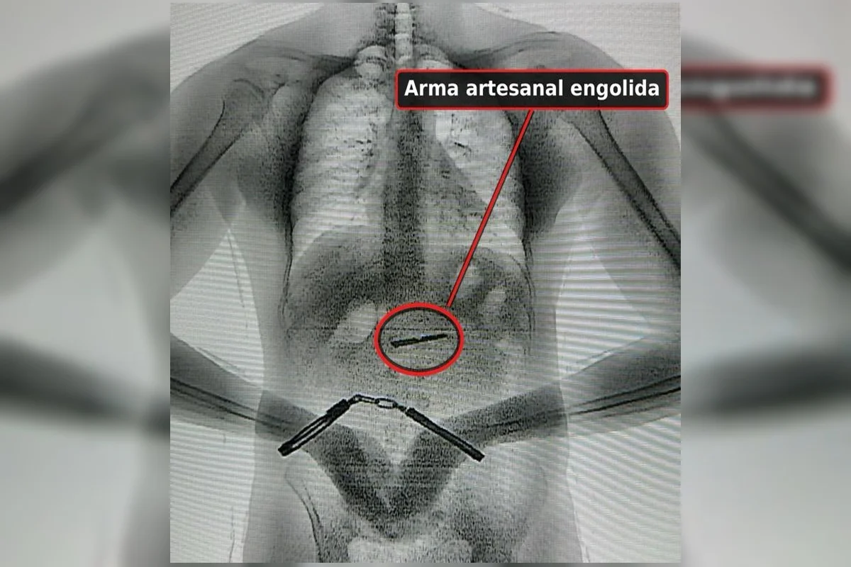 Durante raio-x, uma faca artesanal foi encontrada na barriga de um detento Durante raio-x, uma faca artesanal foi encontrada na barriga de um detento