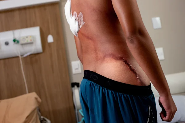 O adolescente Eduardo Linhares, 17 anos, mostra as queimaduras sofridas por queda de raio durante a manifestação de Nikolas Ferreira, na Praça do Cruzeiro em Brasilia Metrópoles 1