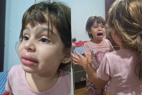 Após sugar uma tampa de desodorante, menina de 5 anos ficou com os lábios inchados por conta da pressão. O vídeo viralizou nas redes sociais - Metrópoles