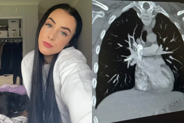 Montagem mostra o exame de Cloe ao lado de foto mostra Cloe, jovem de Melborne que teve um implante contraceptivo que migrou para o coração