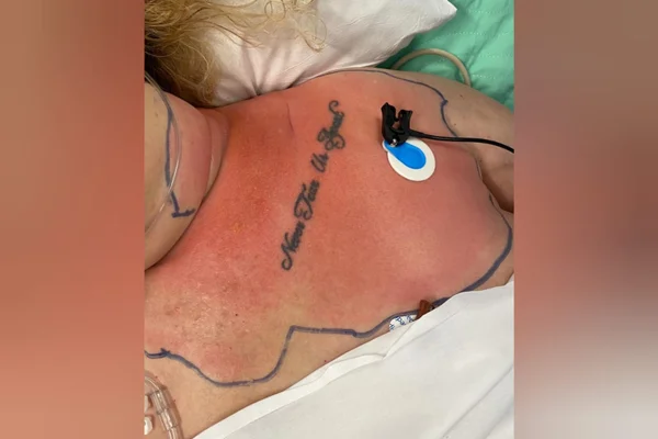 Foto mostra colo de mulher branca com mancha vermelha e uma tatuagem - Metrópoles