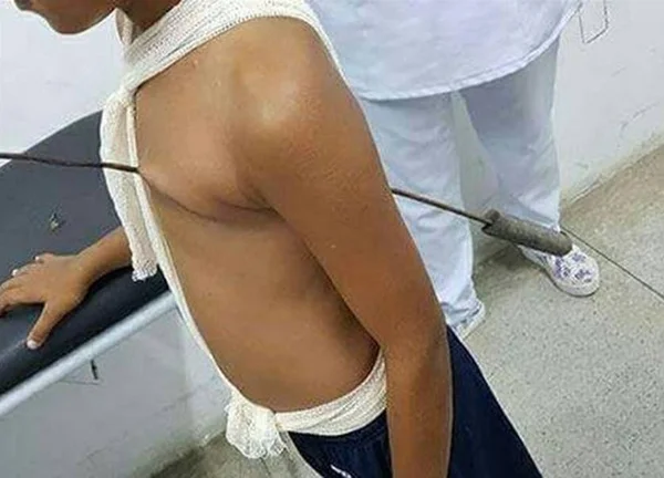 Menino de 11 anos tem o tórax perfurado por espeto de churrasco