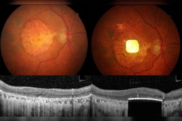 Um dispositivo elétrico implantado sob a retina ajuda a restaurar parte da acuidade visual em pessoas com degeneração macular relacionada à idade. Metrópoles