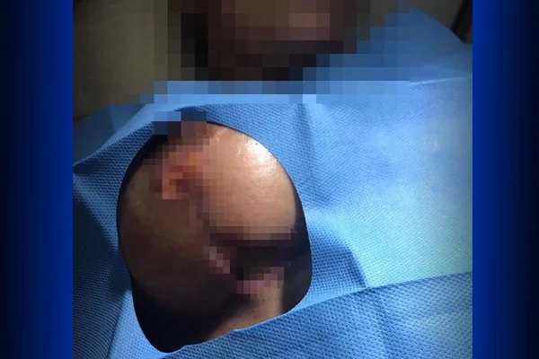 Pacientes denunciam médico após necrose e infecção