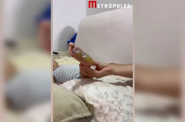 Imagem colorida do pé direito de uma criança. O membro contém bolhas de queimaduras de segundo grau