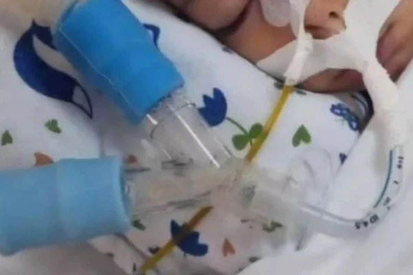 Imagem mostra rosto de bebê com dreno no nariz. Criança está em leito médico de hospital - Metrópoles