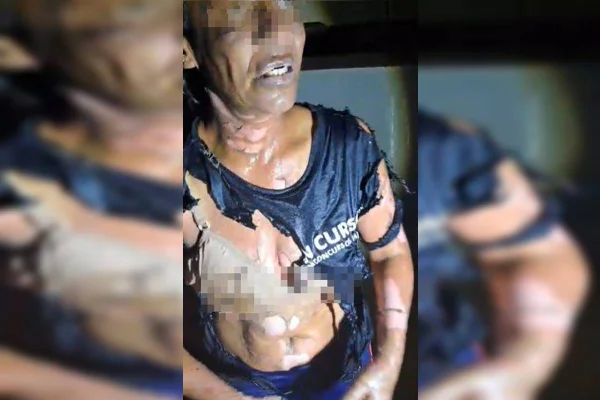 Mulher é vítima de tentativa de feminicídio: "Ele tacou fogo em mim"