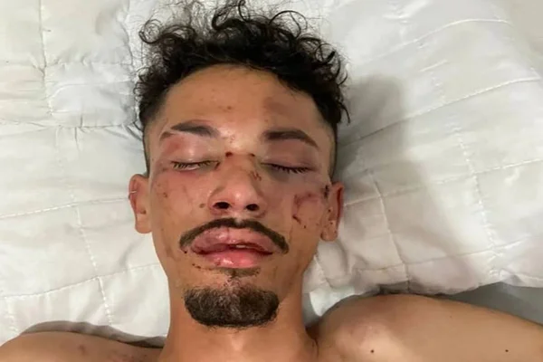 Jovem fica com rosto desfigurado após ser espancado em festa no DF