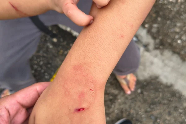 Foto colorida de lesão provocada por mordida de mulher acusada de agredir e torturar o filho, de 11 anos, em São Paulo.