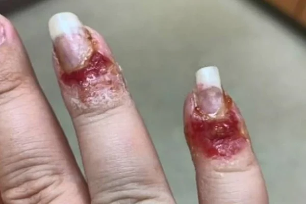 Fungos atacam unhas após mulher usar produto popular em salão