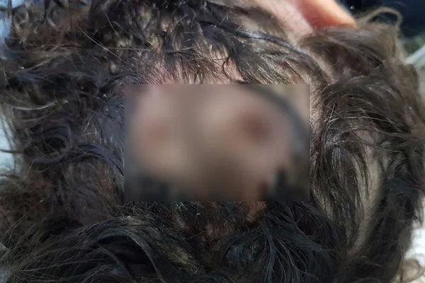 Mãe de menina com larvas na cabeça está com medo de ser linchada
