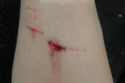 Mulher é atacada por 6 cães ao caminhar em rua no DF e fica ferida - imagem 3 Mulher é atacada por 6 cães ao caminhar em rua no DF e fica ferida - imagem 3