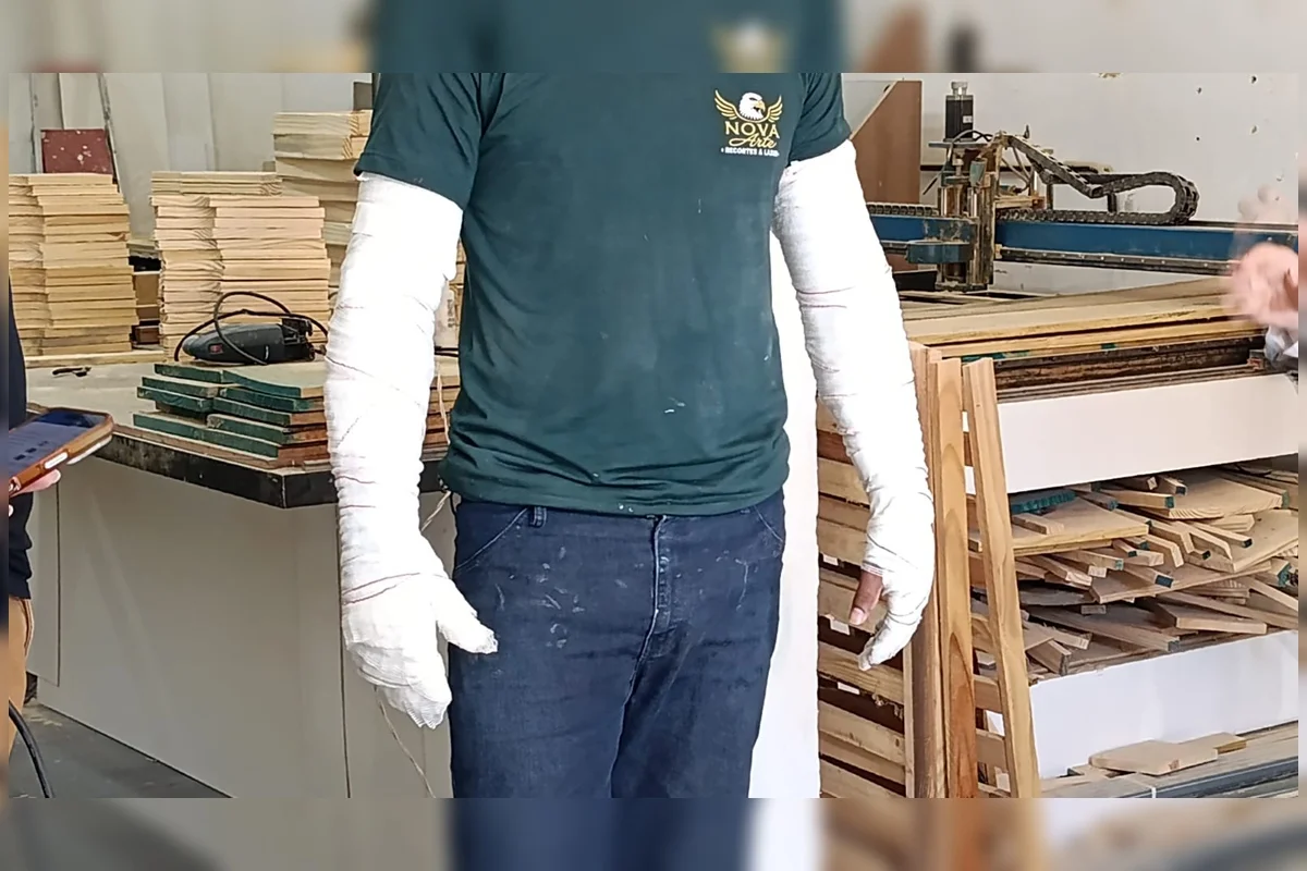 Ele ficou com queimaduras nos braços Ele ficou com queimaduras nos braços