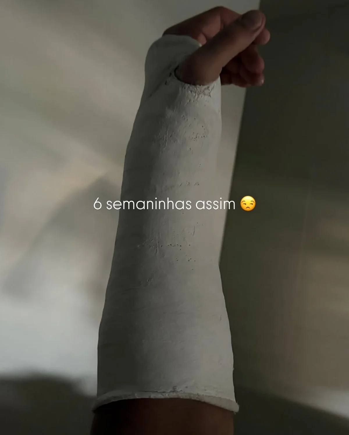 Jonas Sulzbach contou que vai ficar com o braço imobilizado por seis semanas Jonas Sulzbach contou que vai ficar com o braço imobilizado por seis semanas