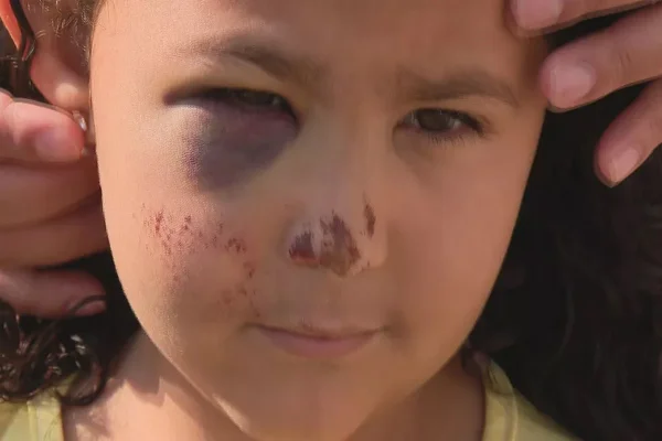 Rosto de menina machucada. Olho roxo, ferida no nariz