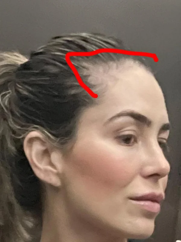 Atriz Joana Cabral revela alopecia após uso de anabolizante - destaque galeria