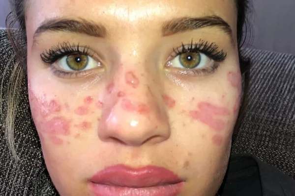Influenciadora alerta sobre trend de beleza após parar no hospital - destaque galeria