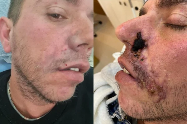 Homem perde parte do nariz após preenchimento labial malsucedido