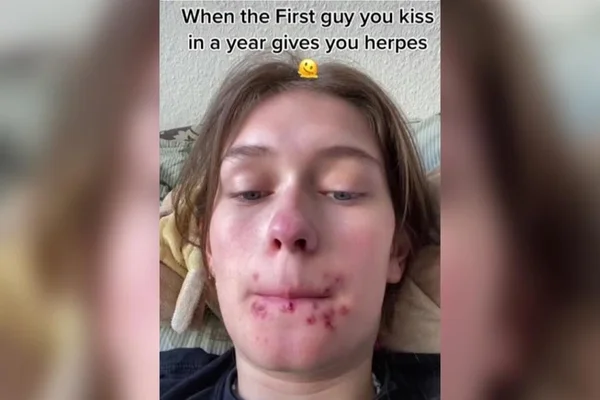 imagem de jovem mulher com feridas de herpes na boca