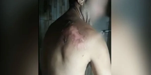 Homem que teve o corpo queimado pela própria esposa