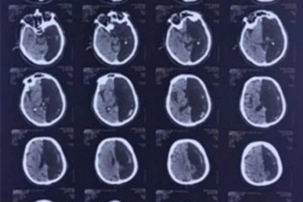 Médicos descobrem que homem de 60 anos só tem metade do cérebro