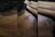 Lesão na testa