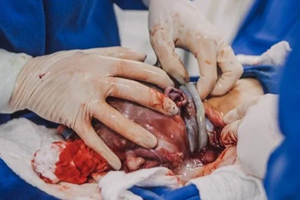 Foto de bebê com cordão umbilical enrolado três vezes no pescoço choca