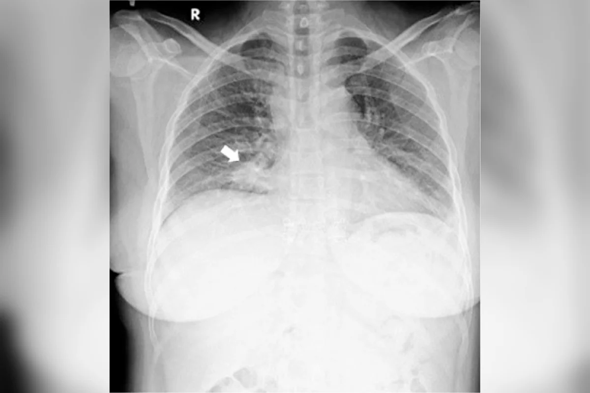 Radiografia de tórax mostrando lesão nodular na zona inferior do pulmão direito Radiografia de tórax mostrando lesão nodular na zona inferior do pulmão direito