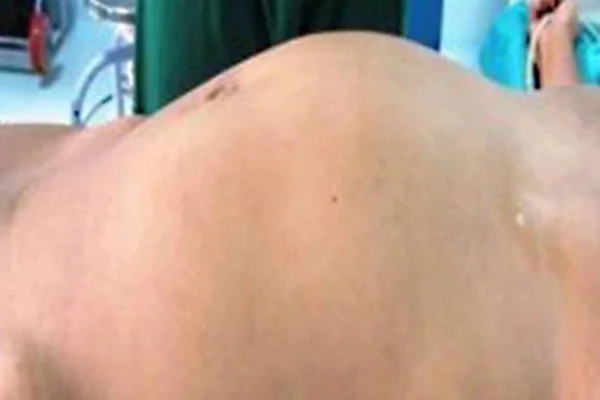 Médicos descobrem que “tumor” na barriga de jovem é gêmea parasita