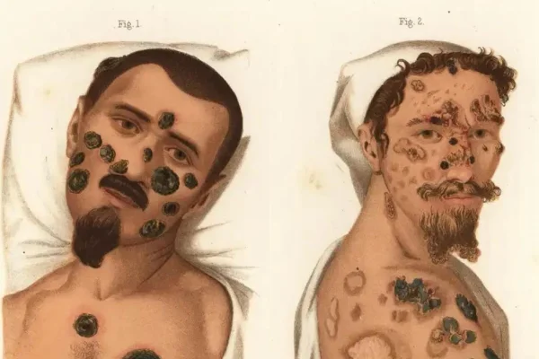 Foto ilustração de homens com sífilis. Metrópoles