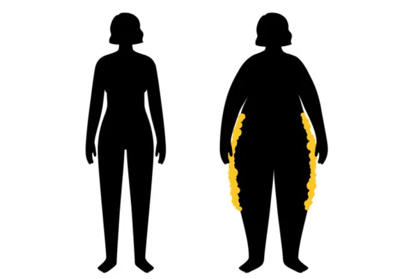 Ilustração representativa de corpo de mulher com lipedema