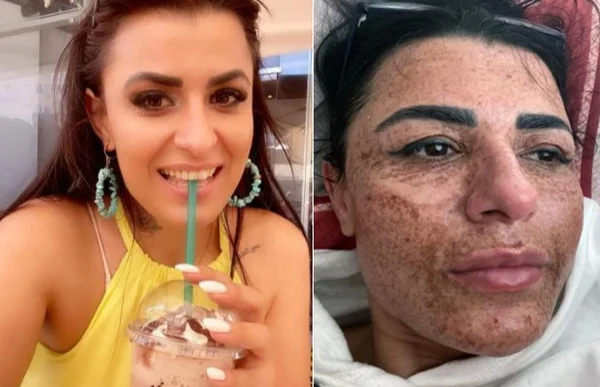 Esteticista se distrai em briga com namorado e queima rosto de cliente