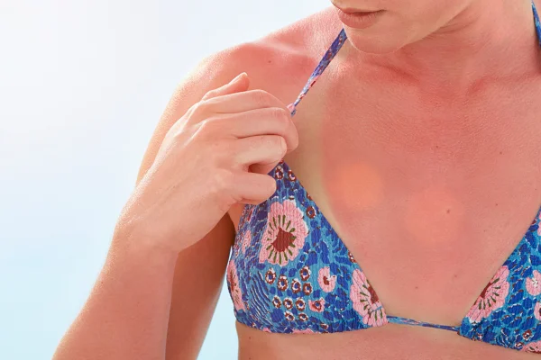 Mulher com queimadura de sol, pele vermelha