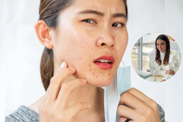 Máscara - pele - dermatologista Karla Lessa