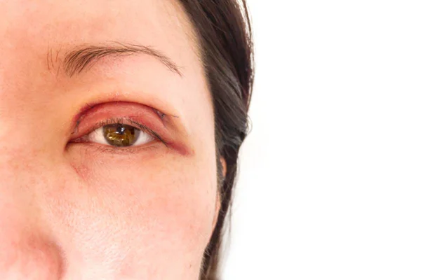 Imagem colorida de mulher com herpes ocular - Metrópoles