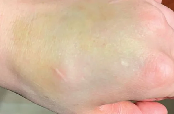 Mulher torce a mão e descobre que hematoma era, na verdade, tumor raro